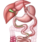 bypass_gastrico_y_de_roux bypass_gastrico_y_de_roux